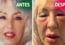 “Parezco una gárgola”, mujer advierte sobre los riesgos de los rellenos faciales