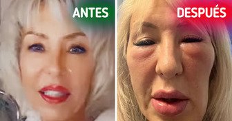 “Parezco una gárgola”, mujer advierte sobre los riesgos de los rellenos faciales